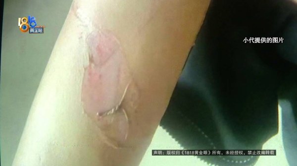 熊猫配资 小伙上班太久，拔火罐想缓解疲劳，结果手臂被烫伤，直接没工作了？